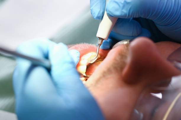Best Emergency Wisdom Teeth Removal in Big Sandy, TX