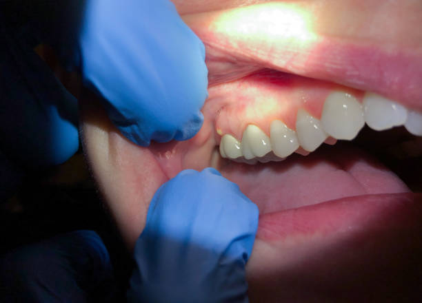 Best Emergency Treatment for Dental Infections or Abscesses in Big Sandy, TX