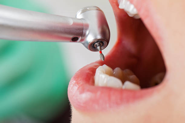 Best Emergency Tooth Extraction in Big Sandy, TX